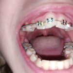 Braces mouth 